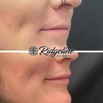 Lip Enhancement Before and After Ridgeline Aesthetics