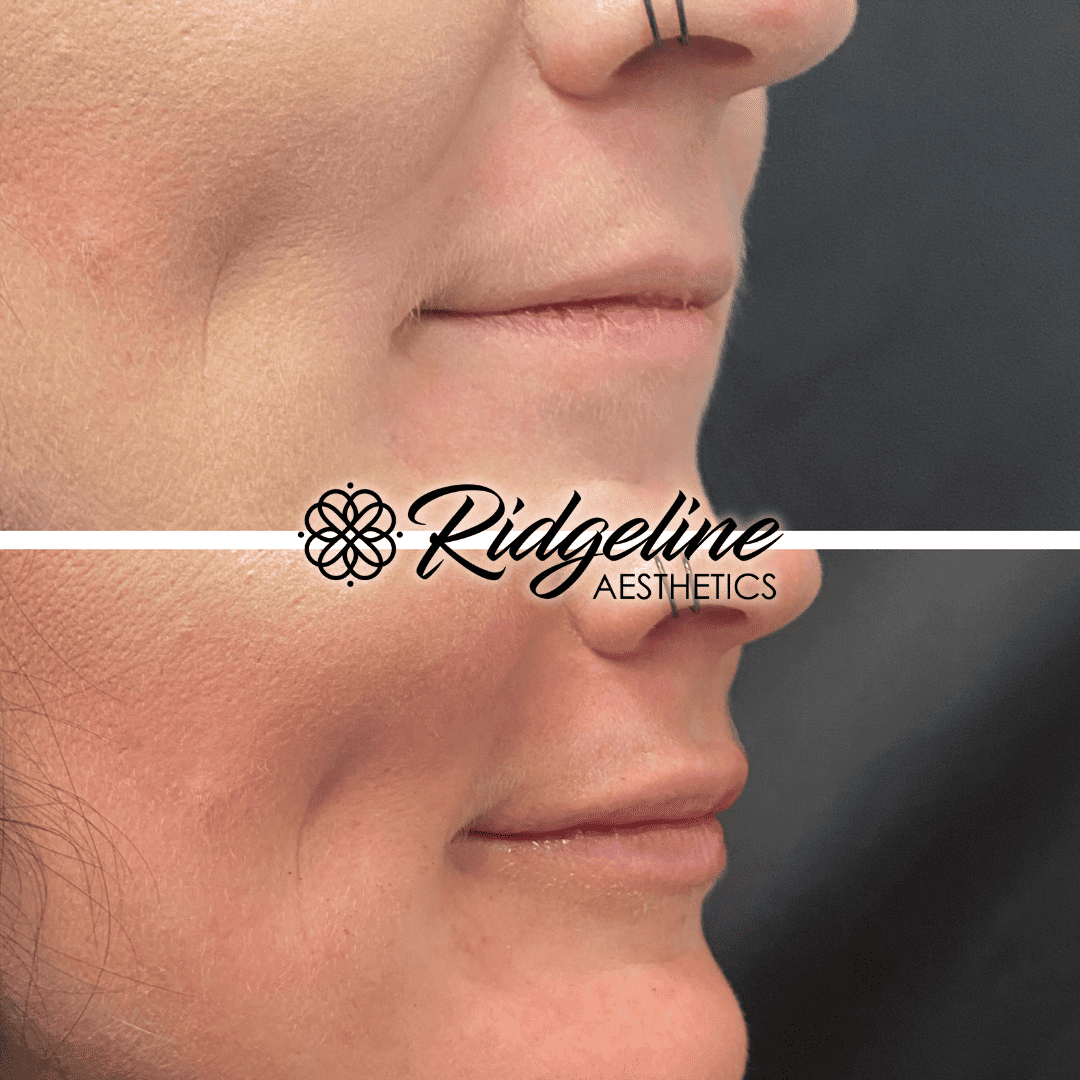 Lip Enhancement Before and After Ridgeline Aesthetics