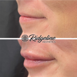Lip Filler Procedure Ridgeline