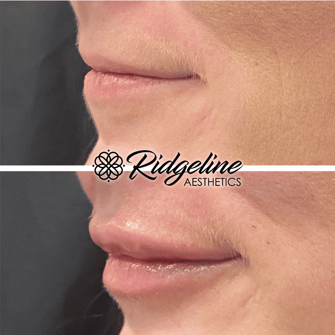 Lip Filler Procedure Ridgeline