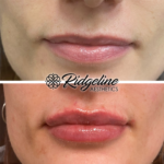 Lip Enhancement Before and After