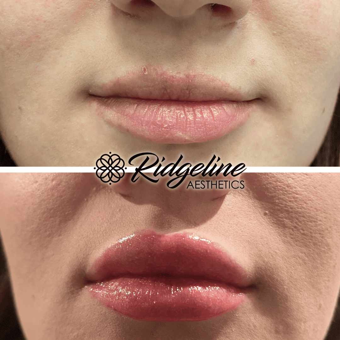 Ridgeline Aesthetics Lip Filler Procedure Before and After