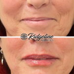 Ridgeline Lip Enhancement Before and After