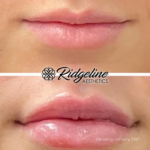 Lip Filler Procedure Before and After