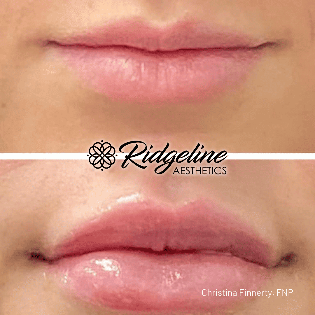 Lip Filler Procedure Before and After