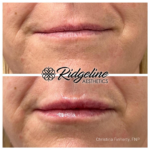 Lip Filler Before and After Ridgeline Aesthetics