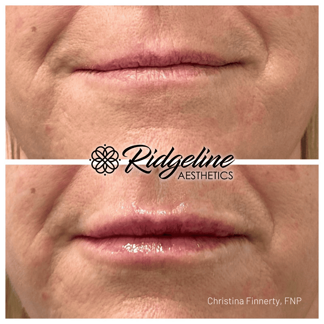 Lip Filler Before and After Ridgeline Aesthetics