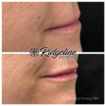 Lip Filler Procedure