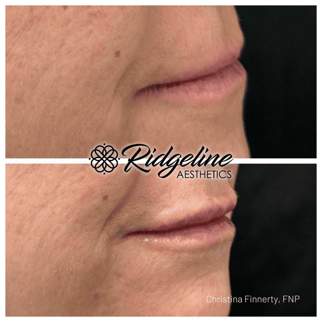 Lip Filler Procedure