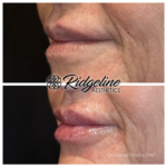 Ridgeline Lip Filler Before and After
