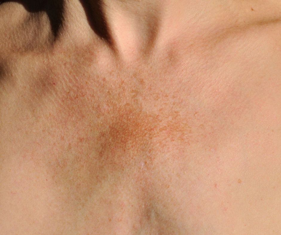 Melasma Treatment, darker skin tone
