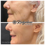 Opus Plasma treatment before and after results