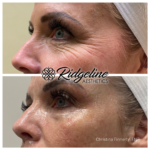 Before and After Wrinkle Removal