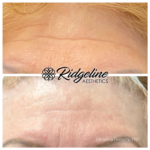 Fine Lines Before and After