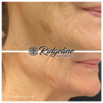 Fine Line Removal Before and After