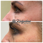 Before and After Fine Line Removal Ridgeline Aethetics