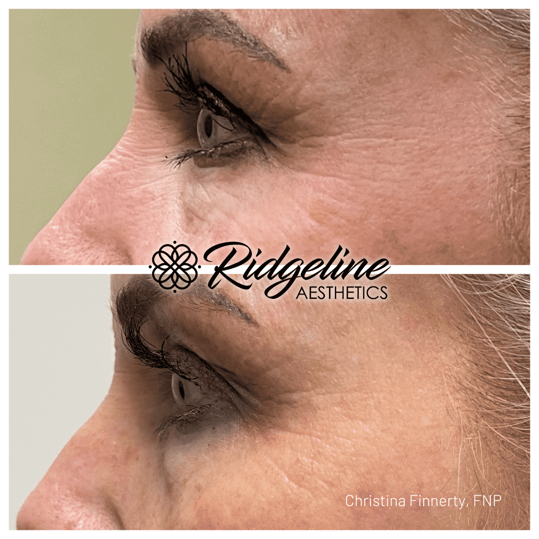 Before and After Fine Line Removal Ridgeline Aethetics