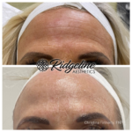 Ridgeline Aesthetics Before and After Fine Line Removal