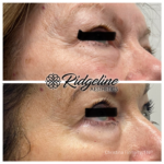 Before and After Wrinkle Removal Ridgeline