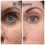 Before and After Fine Line Removal Ridgeline Aesthetics