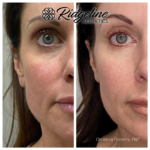 Before and After Fine Line Removal