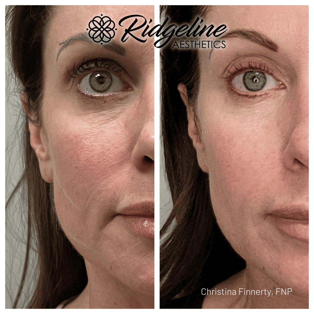 Before and After Fine Line Removal