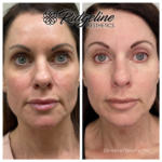 Before and After Beauty Enhancement