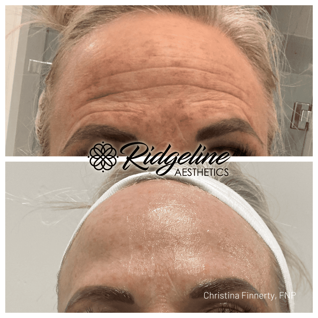 Wrinkle Removal Before and After