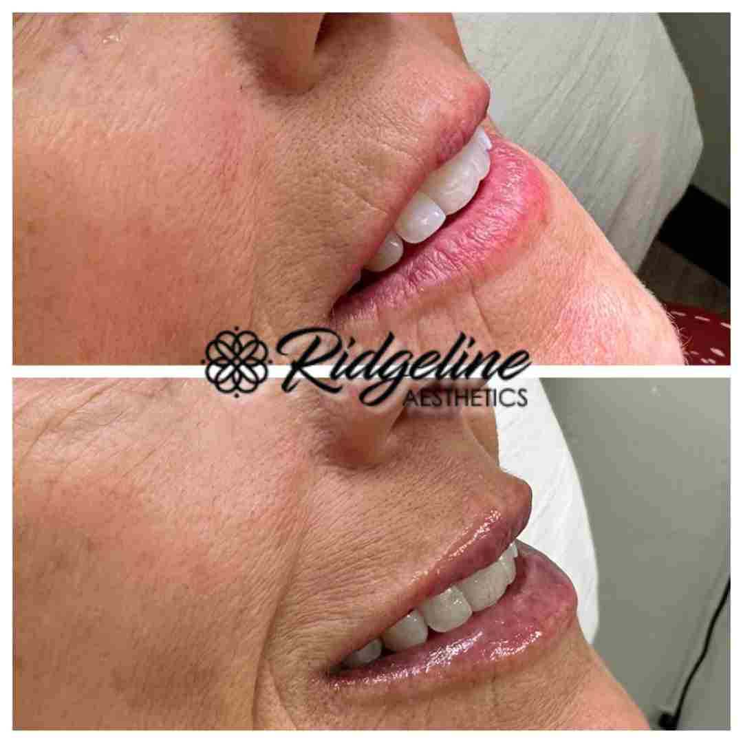 subtle lip filler