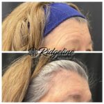 Skin Resurfacing