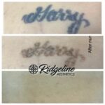 Tattoo Removal Before and After