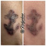 Tattoo Removal