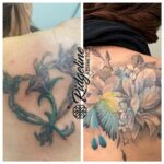 Tattoo Removal