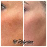 ZO 3 Before and After - Ridgeline Aesthetics