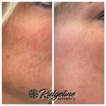 ZO 3 Step Peel Before and After