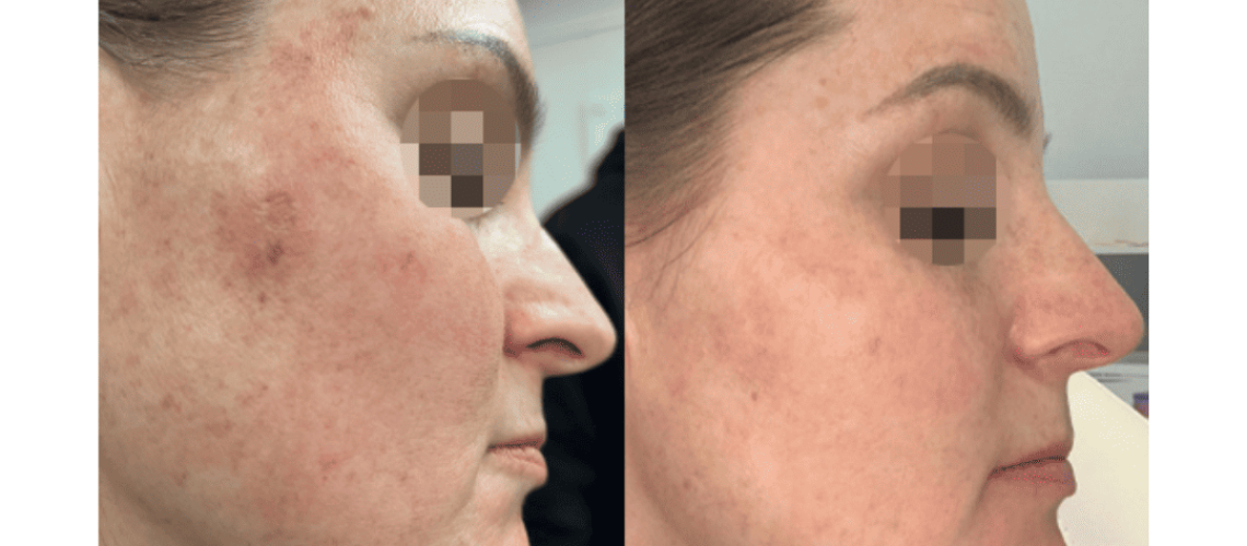 Treat Melasma, Even Skin Tone