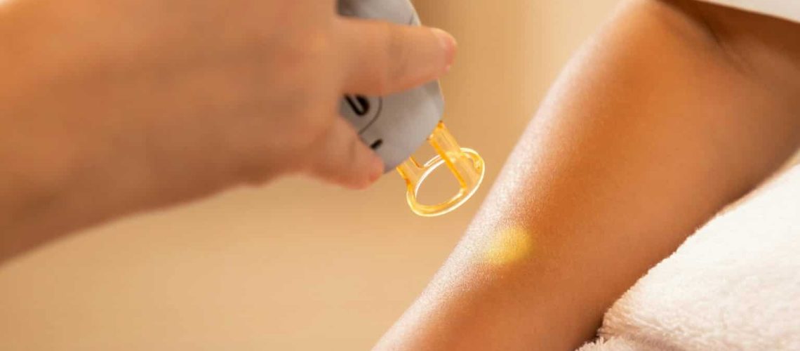 Laser tattoo removal procedure.