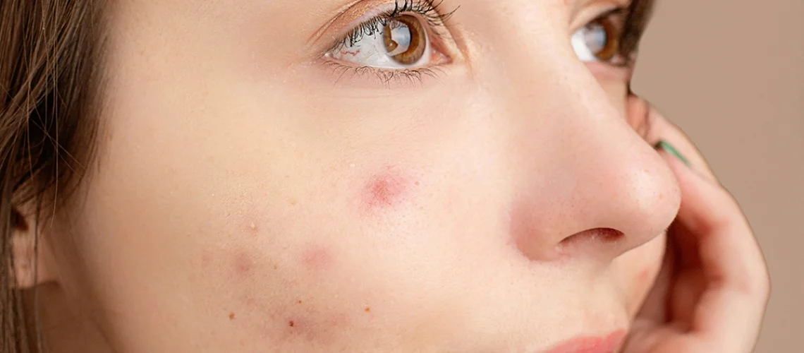 laser treatment for acne scars