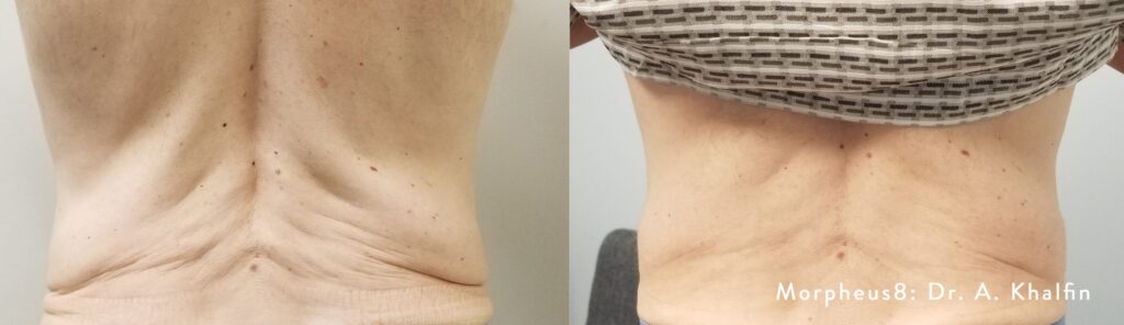 Morpheus8 Body Back Treatment Before/Afters