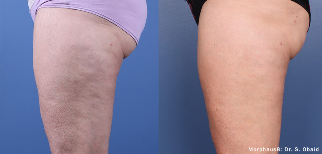 fractional skin treatment