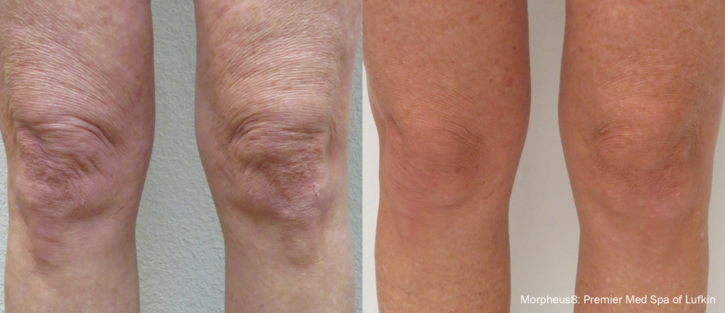 subdermal skin resurfacing