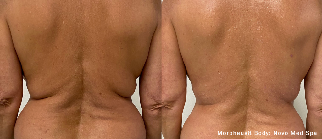 skin resurfacing