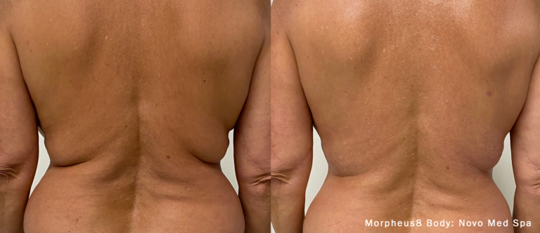skin resurfacing