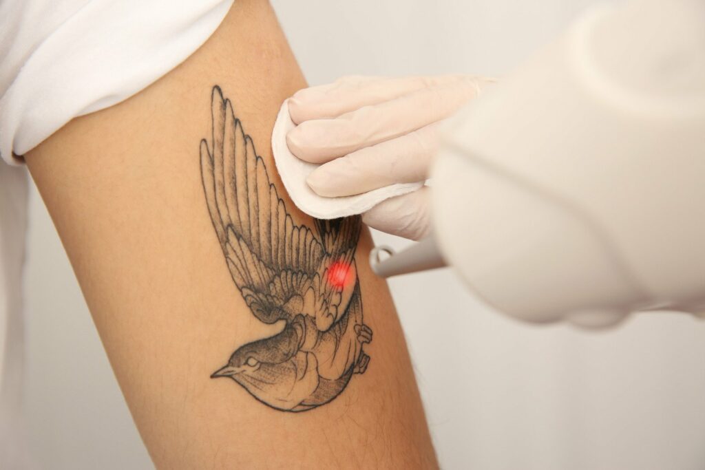laser tattoo removal