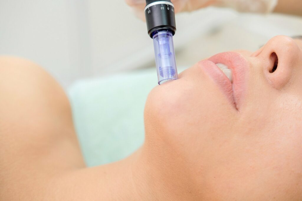 microneedling, skinpen