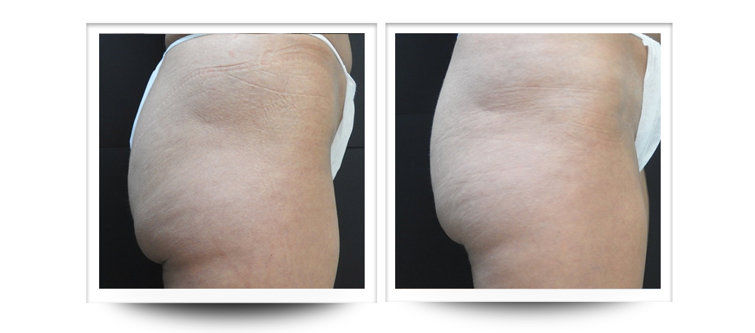Body Sculpting | Buttocks Cellulite Results