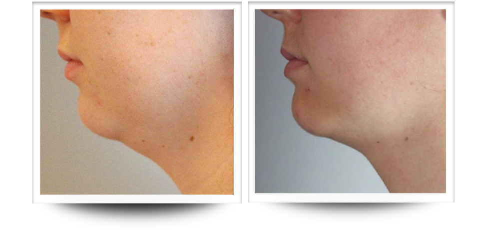 Body Sculpting | Neck Before & After