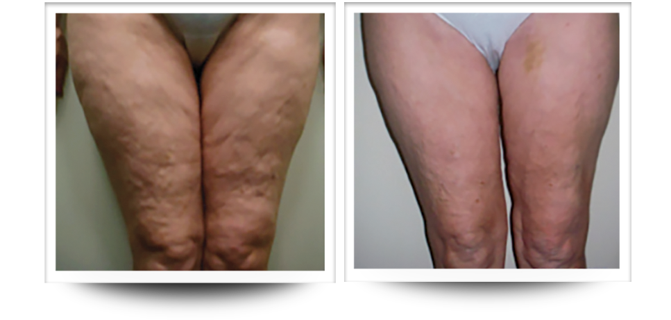 Body Sculpting | Legs Before & After 