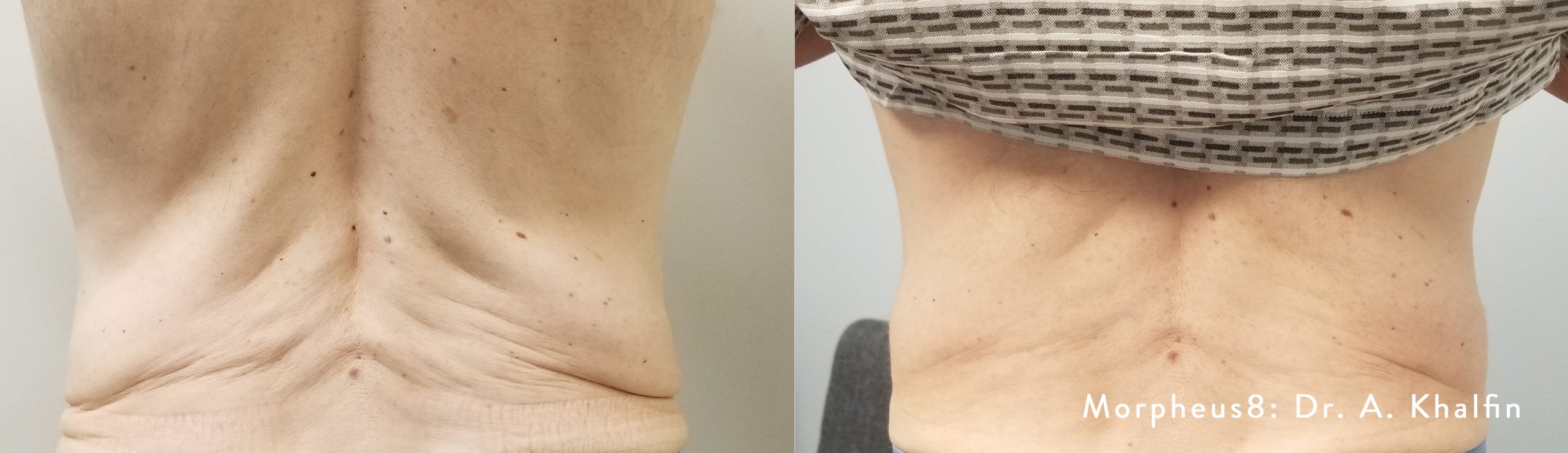 Morpheus8 Body Back Treatment Before/Afters
