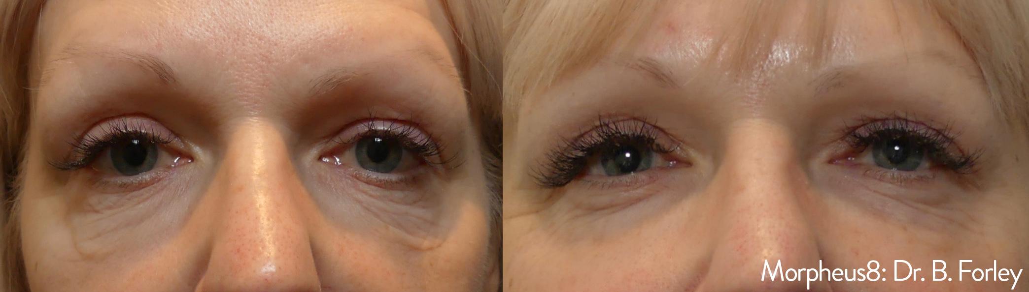 Morpheus8 Under Eye Before/Afters